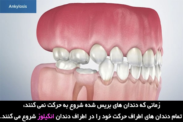 جوش خوردن ریشه دندان به استخوان آنکیلوز