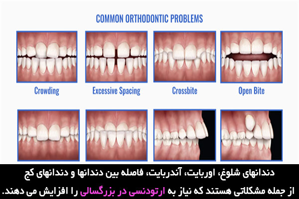 دلایل ارتودنسی در بزرگسالی
