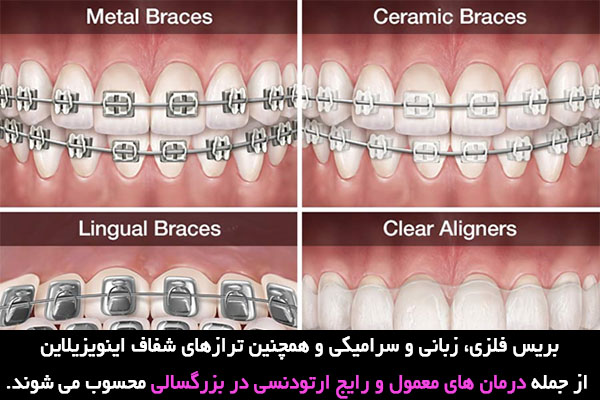 بازه سنی ارتودنسی در بزرگسالی