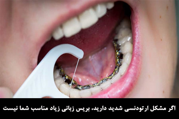 معرفی بریس زبانی در ارتودنسی