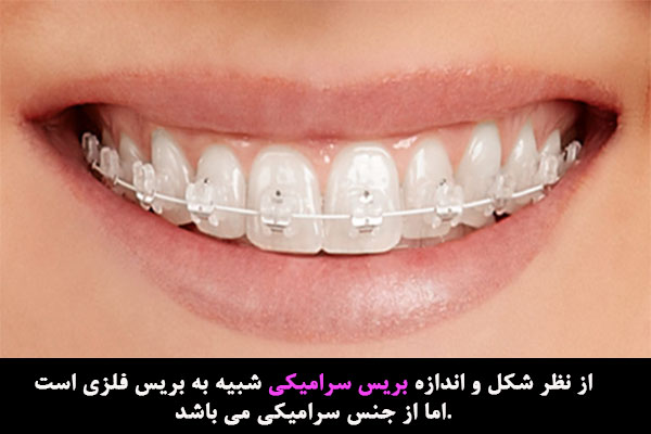 بریس سرامیکی در ارتودنسی