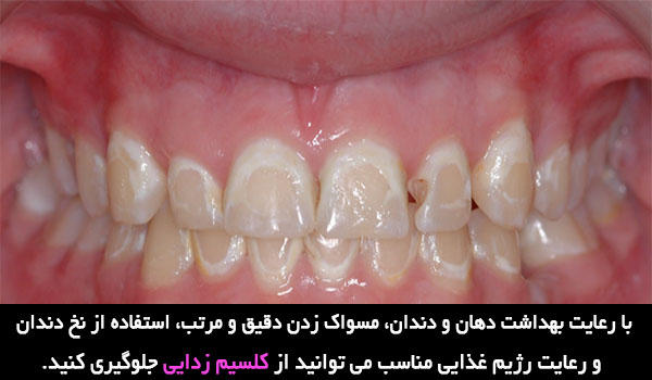 اثرات و عوارض جانبی منفی ارتودنسی