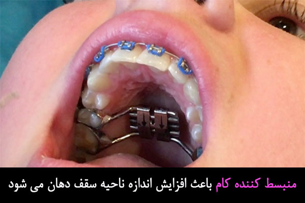 منبسط کننده کام در ارتودنسی