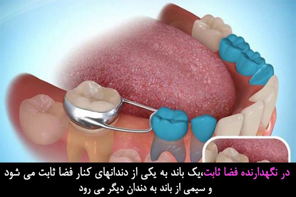 ابزار نگهدارنده ثابت در ارتوندنسی