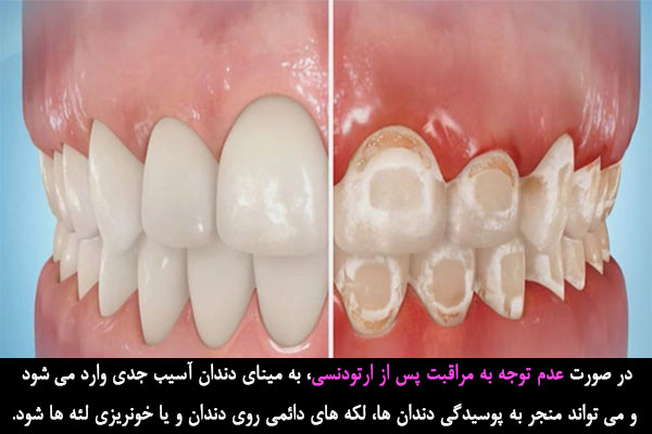 عوارض عدم توجه به مراقبت پس از ارتودنسی