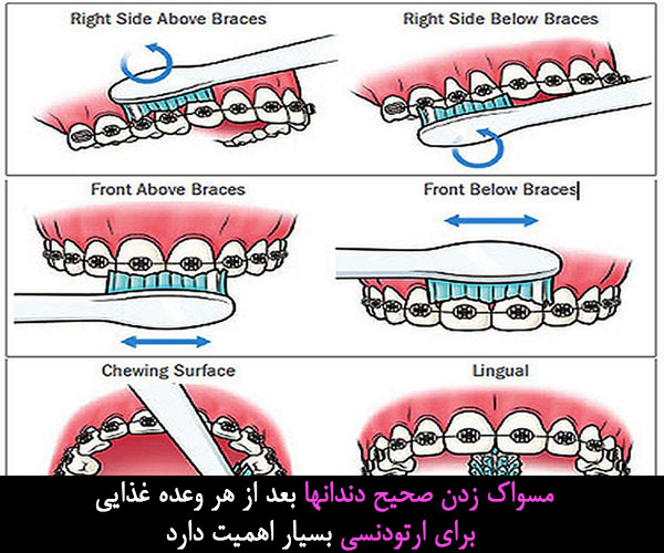 نحوه صحیح مسواک زدن پس از ارتودنسی