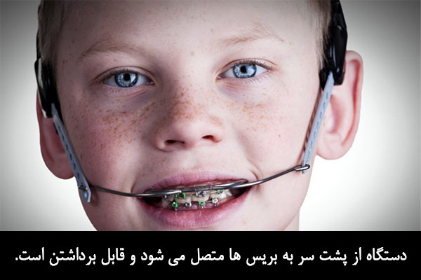 هدگیرها در ارتودنسی کودکان