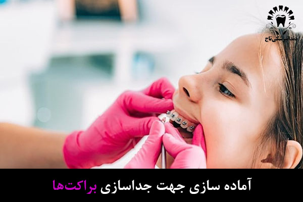 جداسازی براکت ارتودنسی