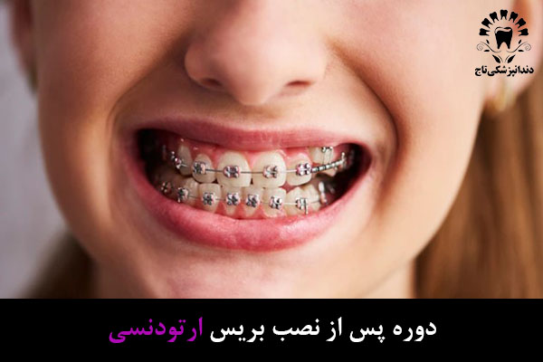 پس از نصب بریس ارتودنسی دندان