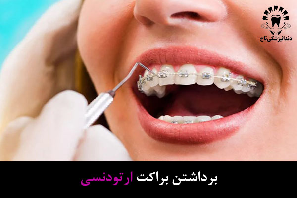 برداشتن براکت ارتودنسی