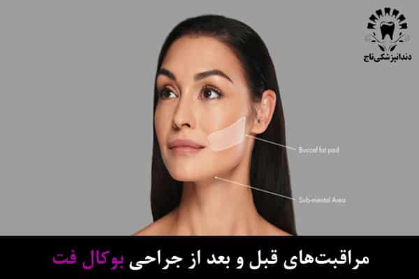 مراقبت‌های مربوط به جراحی بوکال فت