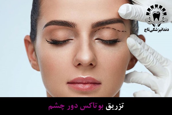 بوتاکس دور چشم
