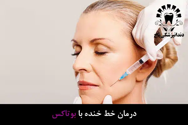 بوتاکس خط خنده