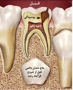 عصب‌کشی دندان کودک با هدف حفظ دندان‌های شیری تا زمان مناسب برای رویش دندان‌های دائمی انجام می‌شود.