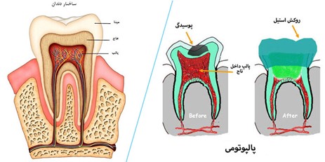 پالپوتومی با توجه به شرایط دندان و سطح آسیب‌دیدگی انجام می‌شود.