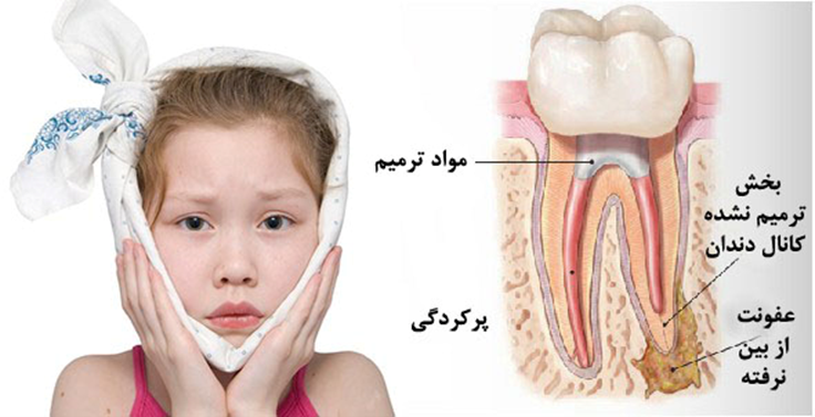 این نوع درمان از درد و عفونت در ناحیه دهان و دندان کودک جلوگیری می­کند.