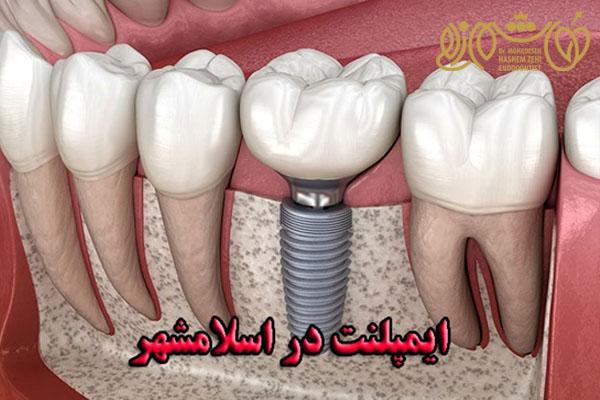 ایمپلنت دندان در اسلامشهر، مشاوره تخصصی و شفافیت در قیمت