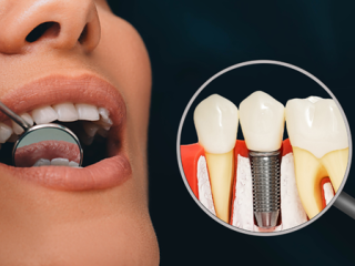 شرایط ایمپلنت دندان چیست و کاشت آن برای چه کسانی مناسب است؟