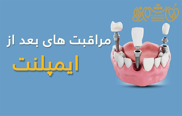 نحوه مراقبت از ایمپلنت دندان