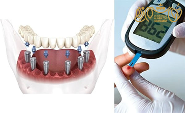 شرایط لازم ایمپلنت برای افراد دیابتی