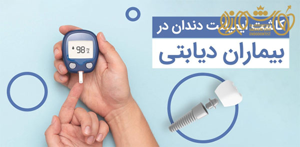 ایمپلنت در اسلامشهر و نسیم‌شهر برای افراد دیابتی