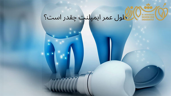 دوام و ماندگاری ایمپلنت دندان